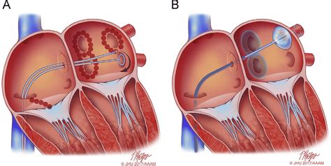 procedure for atrial fibrillation